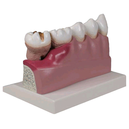 Dentalmodell Unterkieferzähne 3–7 auf farbiger Modellplatte